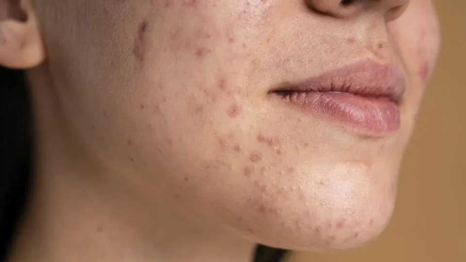 Saúde da pele: alimentação saudável pode controlar acnes na adolescência